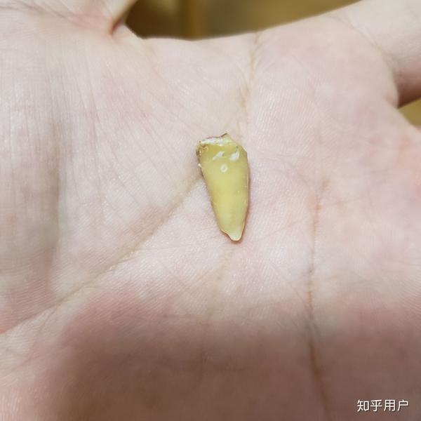 病牙(35牙位)拔掉了,爽! 不算打麻药的时间,总共敲了5锤子就下来了.