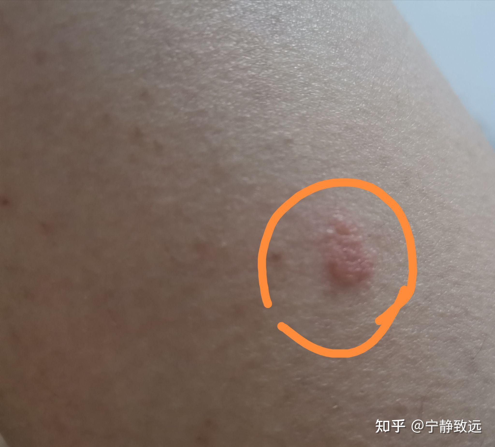 皮肤上有红色凸起这是什么原因