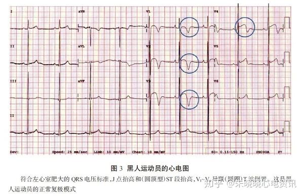 运动员心电图解析的国际建议