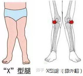 膝外翻畸形疼痛难忍dfo截骨矫形保膝不置换保肢专家文根