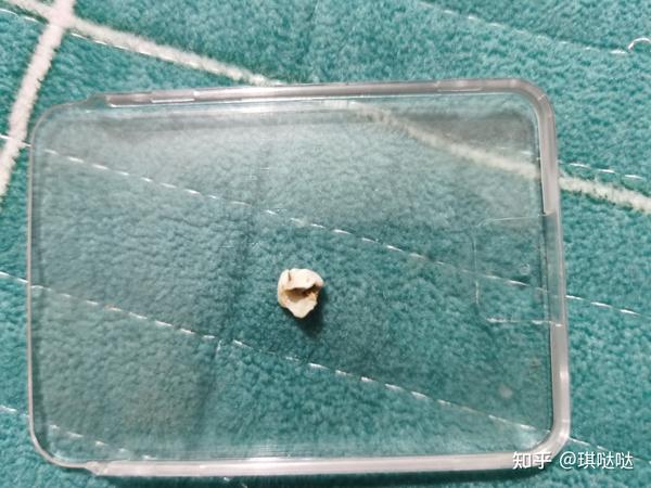 根管治疗亲身经历分享