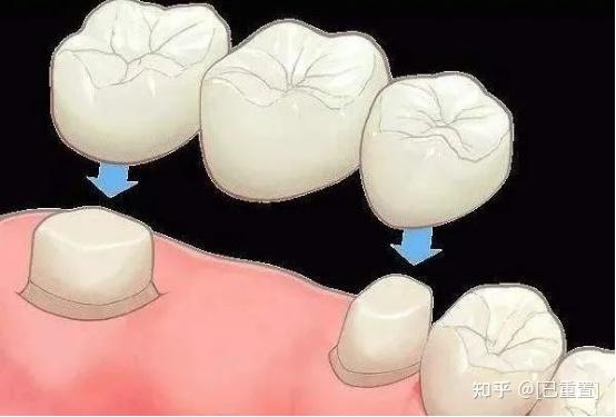 牙齿缺失的三种修复方式