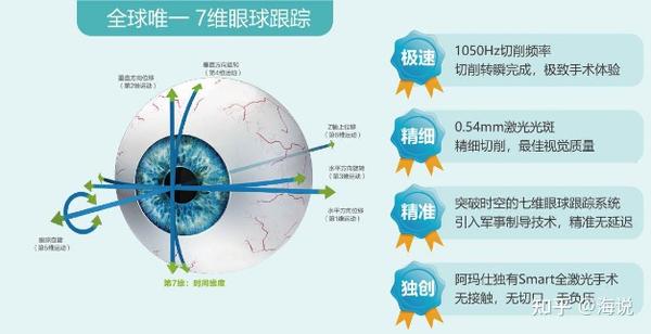 近视手术smart全激光不接触眼睛就能做手术