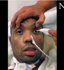 角膜眨眼反射就是在有物体快速接近人眼