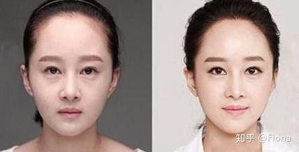 第一步:画出新发际线,在局麻下切除发际侧头皮多余毛发部分额头的