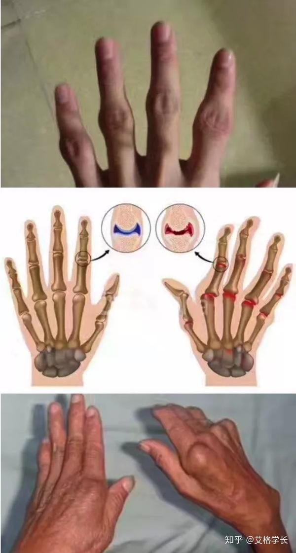 △类风湿性关节炎的手指