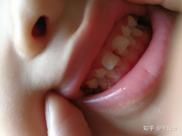 小孩牙齿这样是什么问题?
