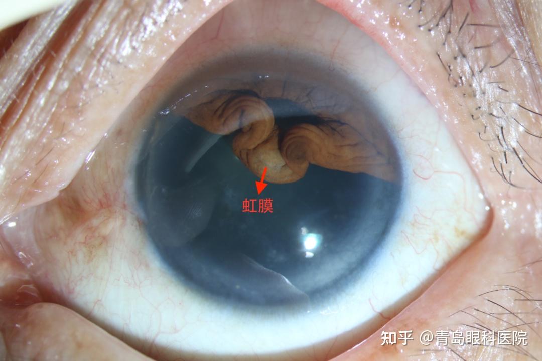 经过检查李主任发现患者左眼的虹膜根部大范围离断,虹膜向上方蜷缩