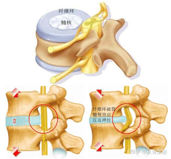 腰椎间盘突主要是由于腰椎生物力学平衡失调,造成腰椎间盘变性,纤维