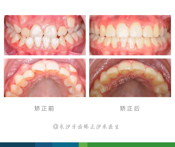 主诉:牙齿反颌(地包天),牙齿稀疏,虎牙高位 这样的错颌畸形问题不仅