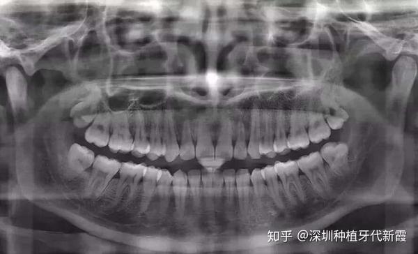 牙医总是让拍口腔全景片,这到底是什么东西?有什么用处?