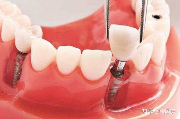 通常来讲,种植牙失败的症状有以下几点: 1,种植牙的牙根松动,脱落出来