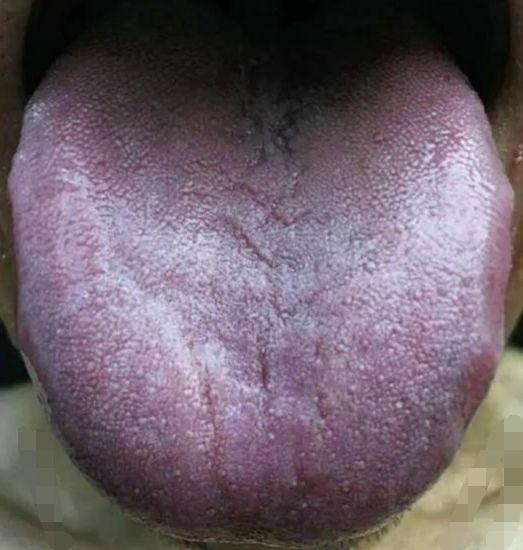 这样的舌头就要警惕癌症