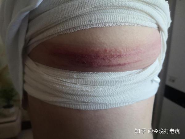 男性乳腺增生手术过程