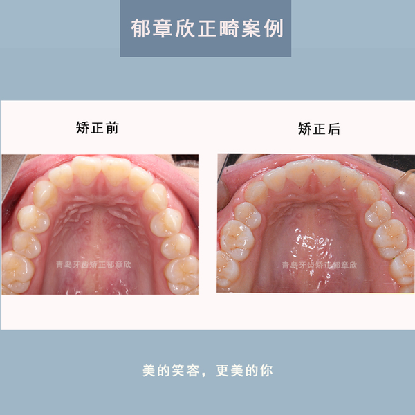 青岛舌侧矫正:牙齿矫正对面型的变化可以有多大?