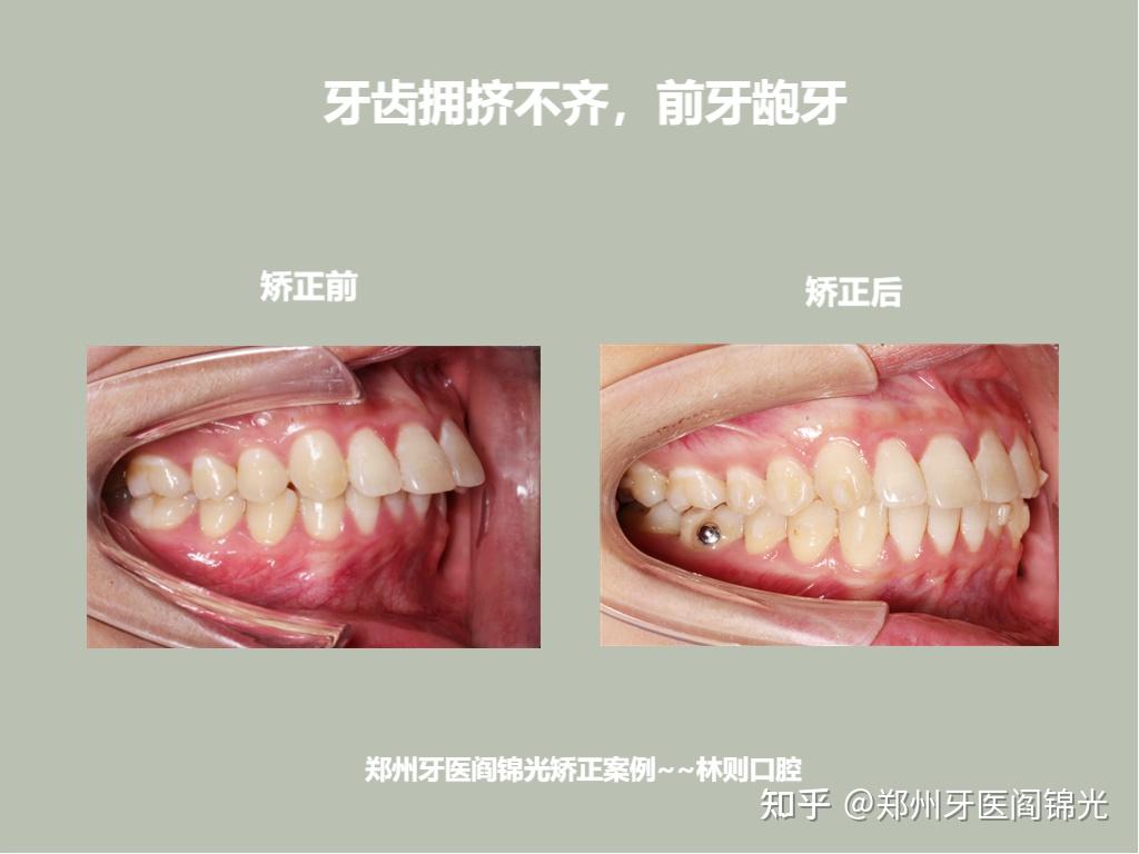 矫正前前牙为深覆盖(龅牙),矫治后前牙为浅覆盖.