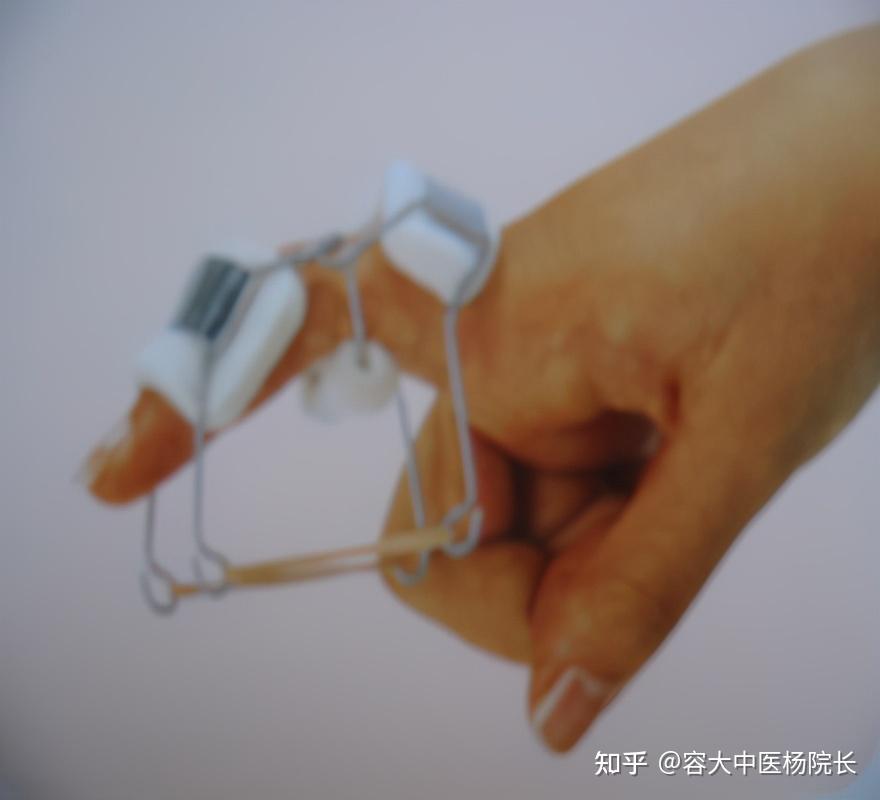 固定矫形器:将近侧指间关节固定于微屈位1,手指鹅颈变形用矫形器手