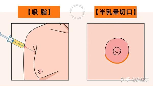 通过半乳晕切口可以切除增生的乳腺和结缔组织,使胸部达到良