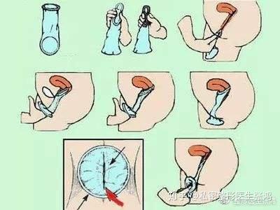 私密医生告诉你:女人在不同时期的安全避孕方法?