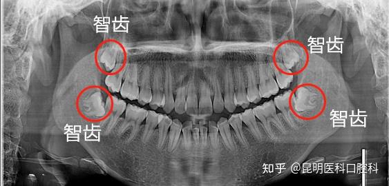 智齿拔还是不拔