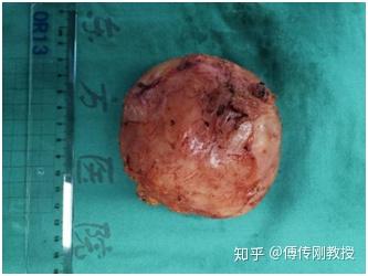 痔疮?直肠癌?原来元凶还有他——骶前肿瘤