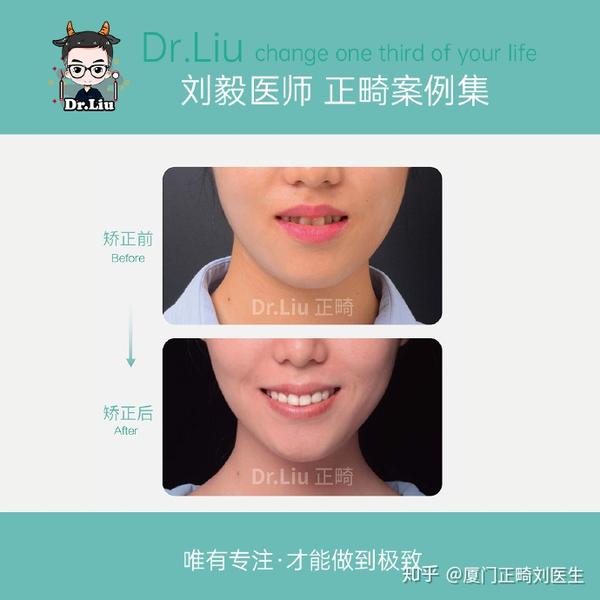 厦门牙齿矫正:牙齿不齐