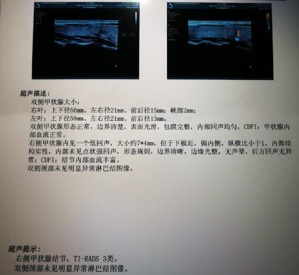 1/3的人都有的甲状腺结节,怎么买保险才能赔?