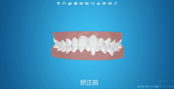 苏世平:儿童可以用隐形牙套矫正牙齿吗?