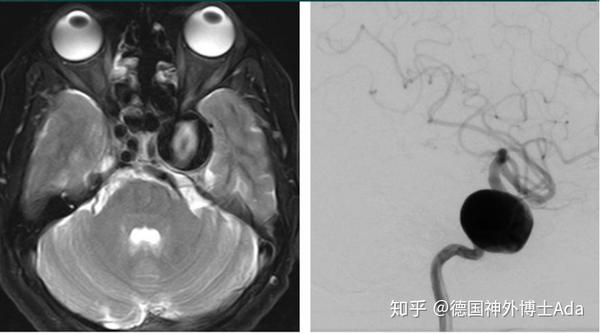 世界海绵窦手术大师解析不同海绵窦肿瘤的手术决策