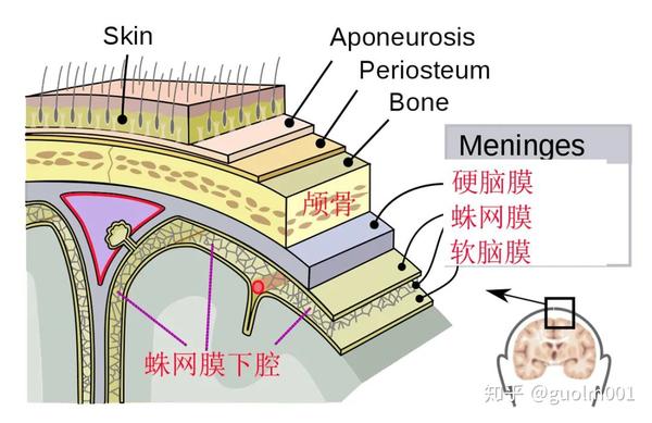 一生中最严重的头痛—"动脉瘤性蛛网膜下腔出血"