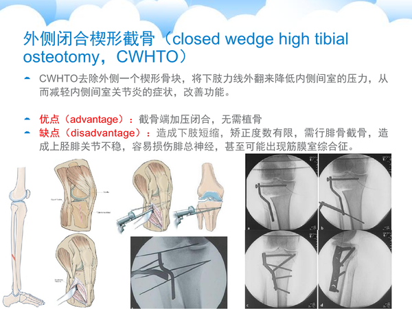 内固定-两种截骨方式比较-胫骨高位截骨术-胫骨内侧开放楔形撑开截骨