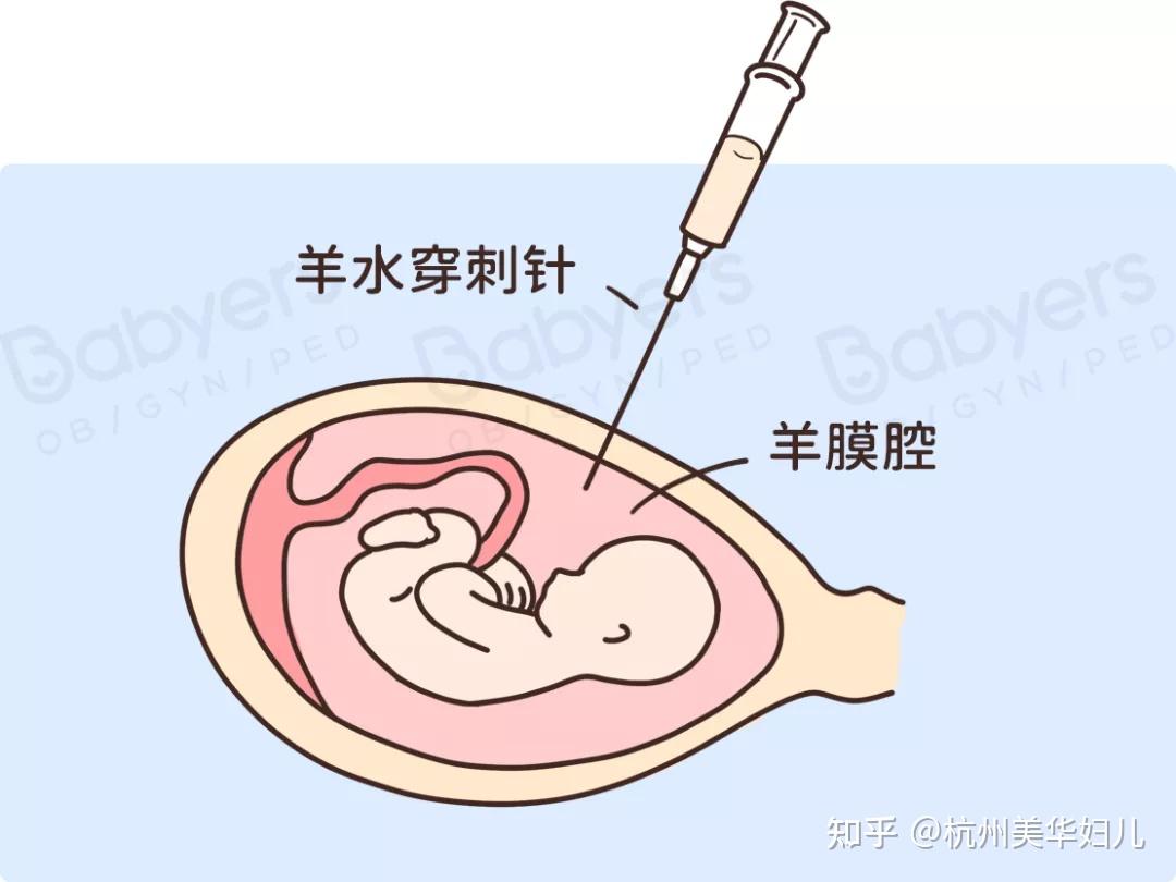 随着年龄增加,胎儿是唐氏综合征的风险会明显上升,但羊膜腔穿刺流产率