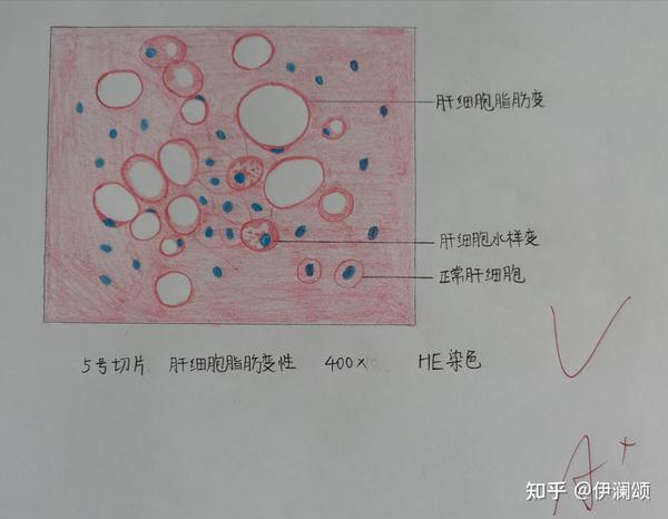 浆细胞:卵圆形,胞浆蓝紫色(红蓝都涂),核呈车辐状,偏向一侧,核
