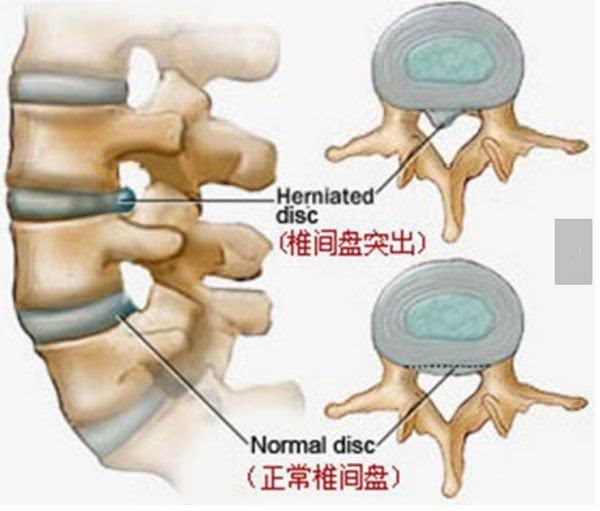 腰椎间盘突出者疼痛状.用中药外治腰椎间盘突出秘方