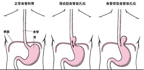 ②钩形胃:胃底和胃体斜向后右下或垂直,幽门靠近脊柱右 侧缘,略高于胃