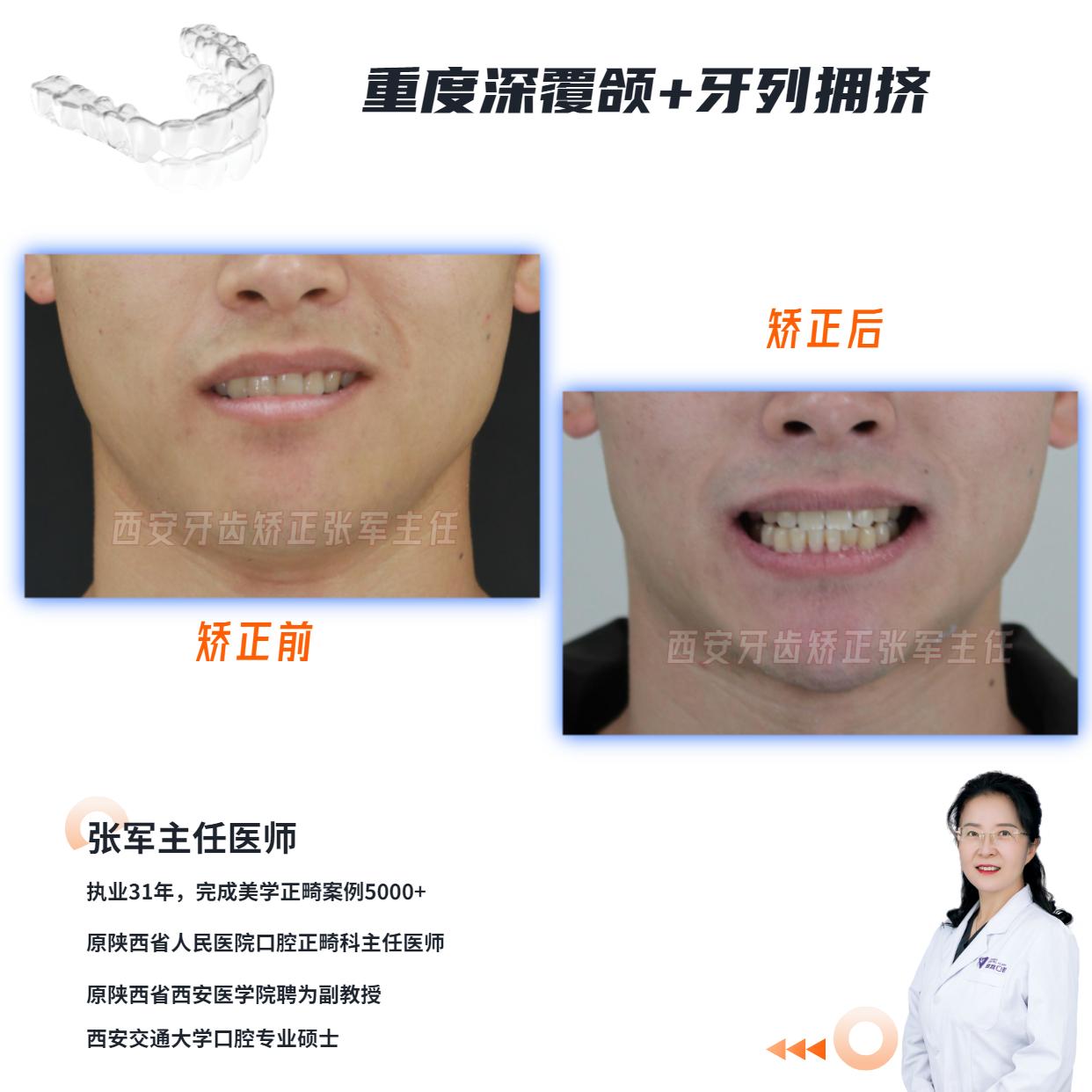 西安牙齿矫正重度深覆颌是前牙牙槽骨高度过大而后牙牙槽骨高度不足