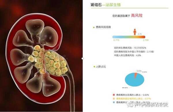 肾结石