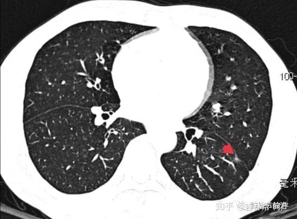 肺结节读片(11:磨玻璃结节胸膜侵犯的预测因素