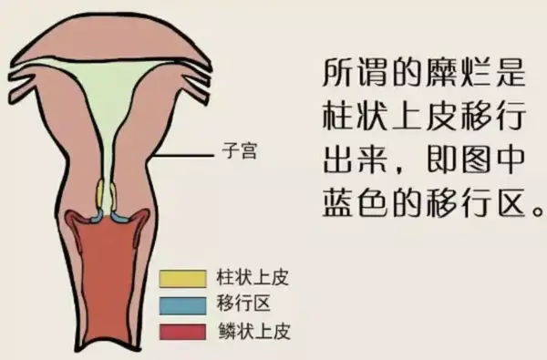 2,既然宫颈糜烂不是疾病,也就没必要分程度