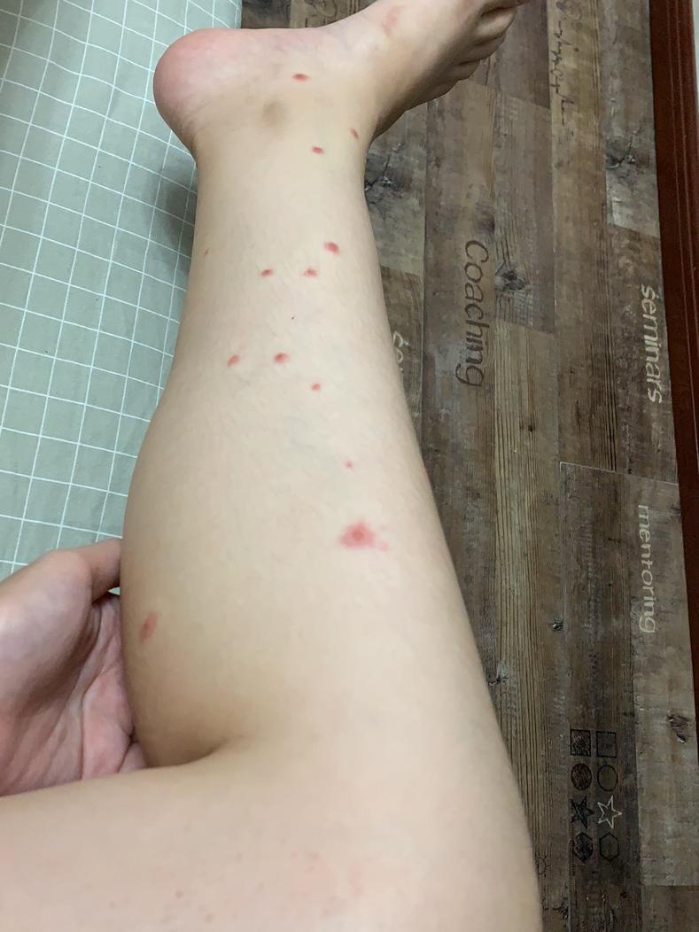 此时,距离被咬已经有八天了,我发现这个不是单纯的蚊子叮咬,立马查了