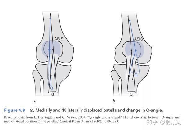 必须保证肌肉力量,避免膝关节内扣,同时适当参考q角,不过q角的测量