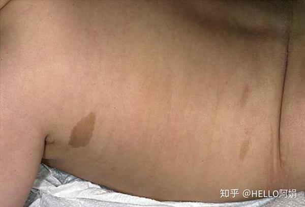 宝宝身上有胎记要治疗吗?说说不同胎记该如何应对