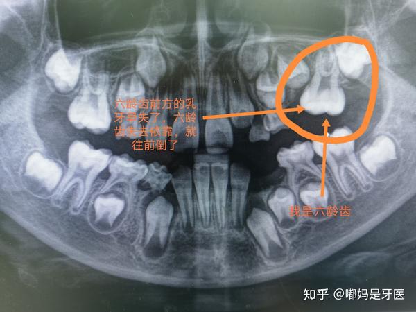乳牙缺失后最重要的事,先检查要不要做缺隙保持器
