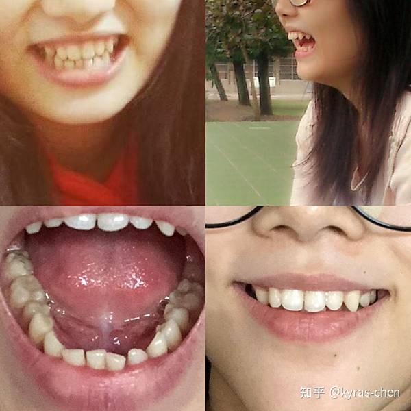 一些牙齿天生比较小,有些尖尖的,而且又缺牙,导致我的牙齿稀疏有牙缝.