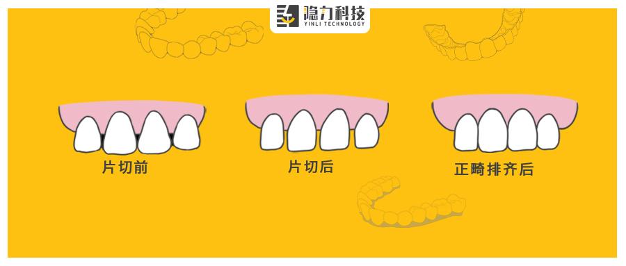 医护需知:邻面去釉(片切)的要点和注意事项