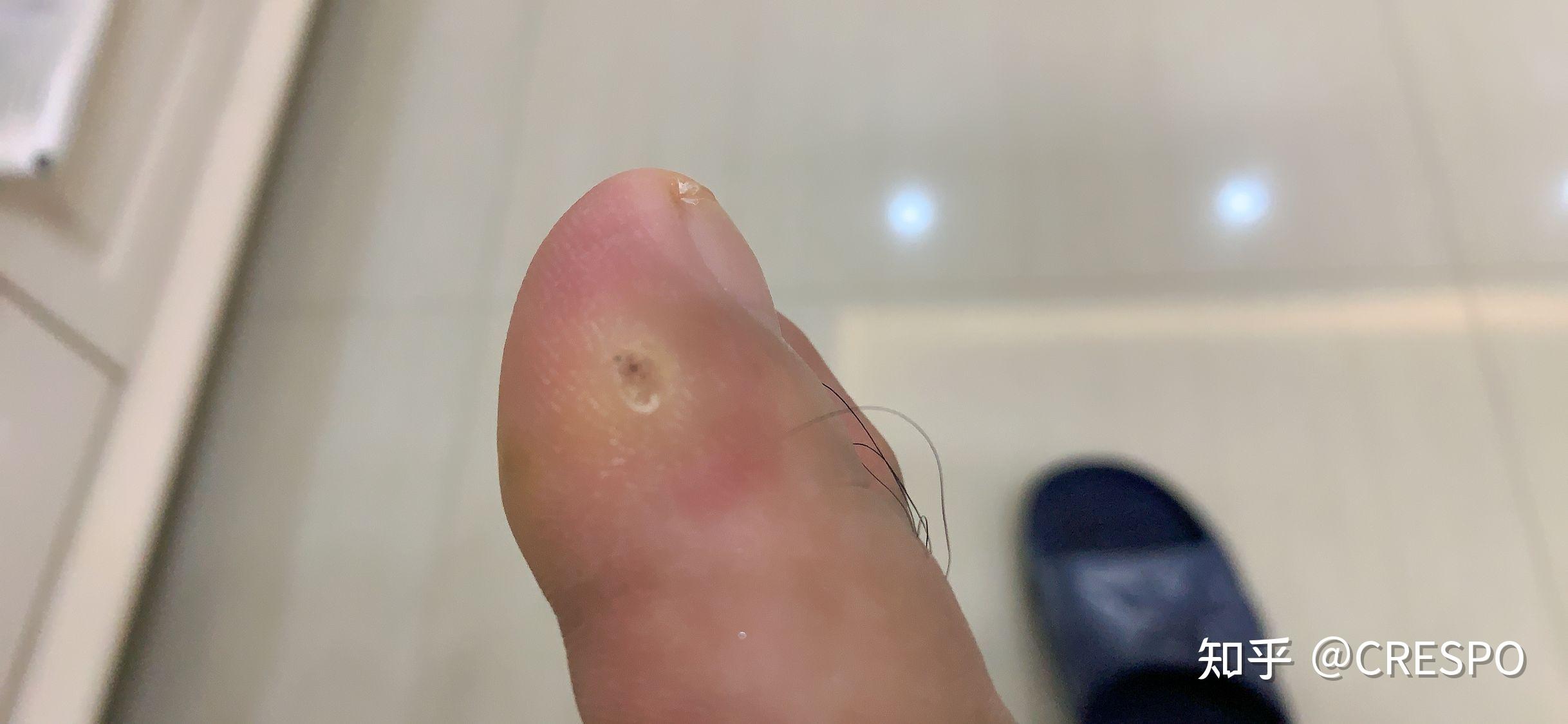 怎么分辨鸡眼还是趾疣趾疣治疗过程