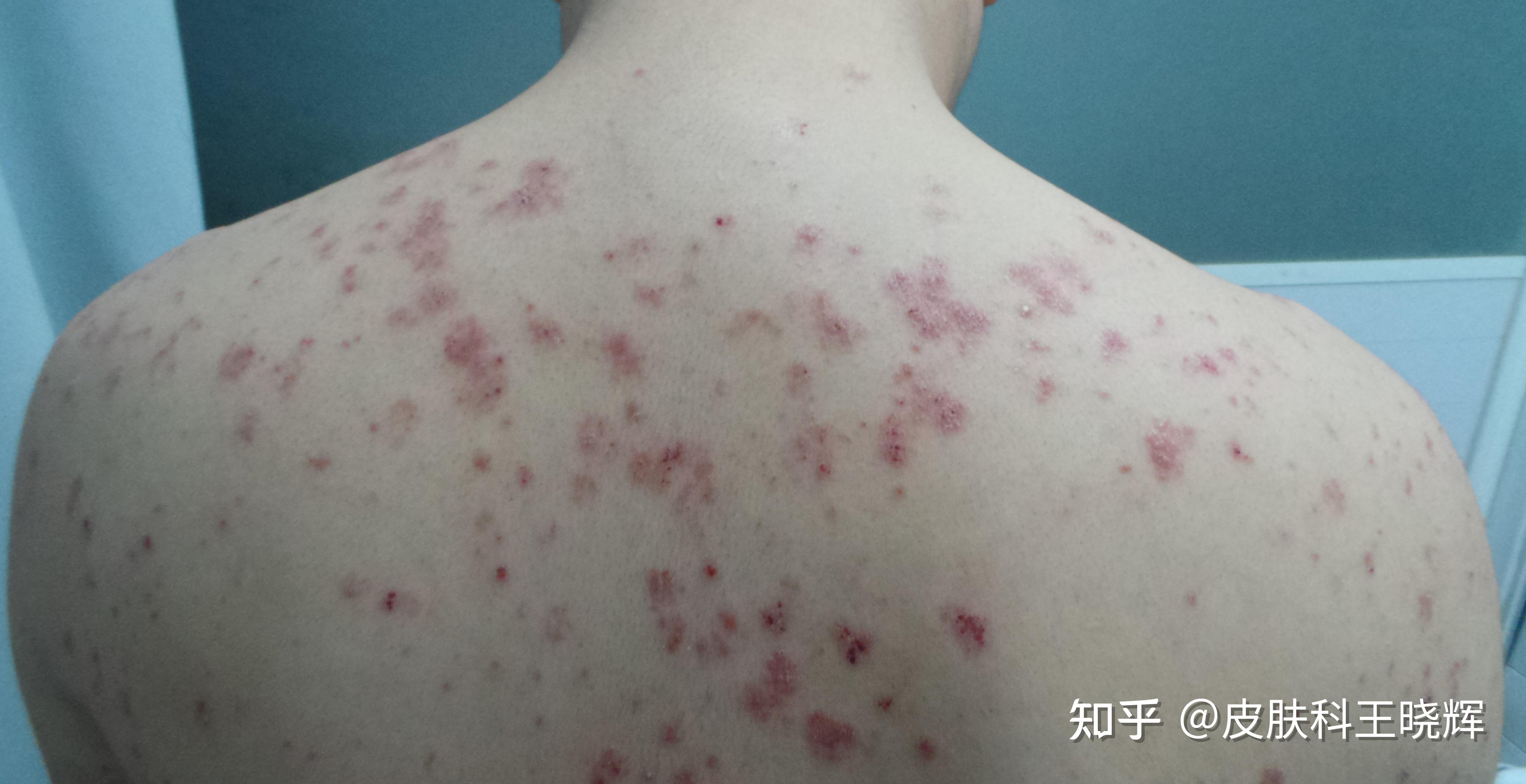 银屑病的病名来历——牛皮癣