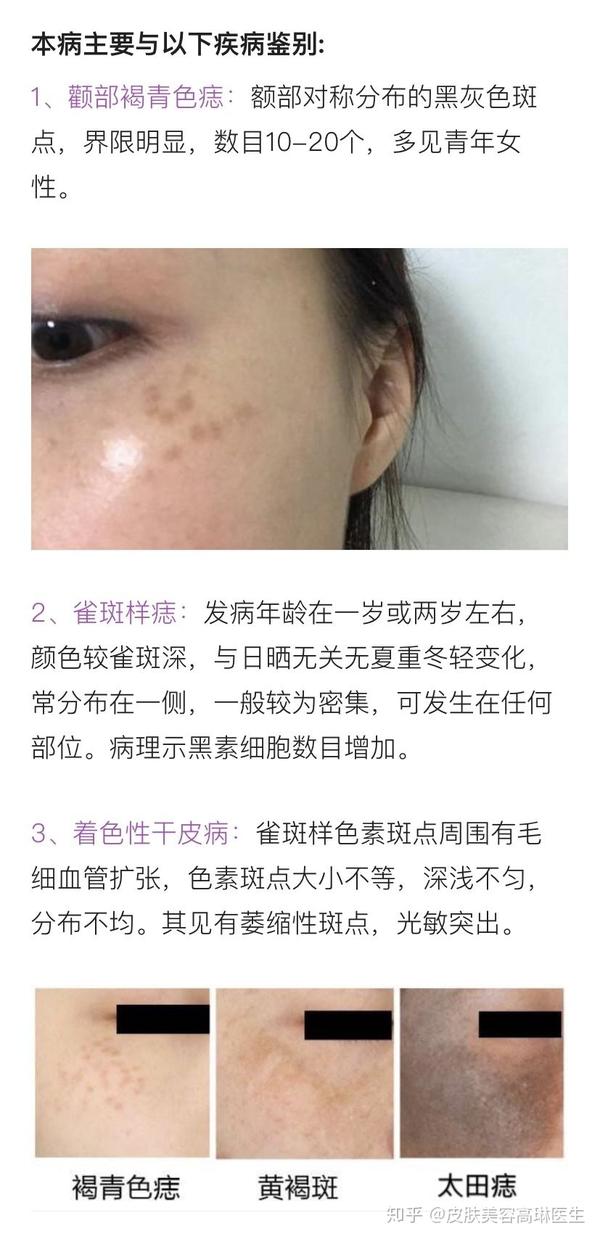 先了解自己脸上的斑点,才能对症下药!