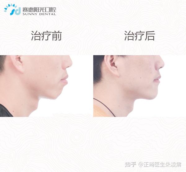 嘴凸导致颏肌紧张下嘴唇外翻可通过矫正来解决
