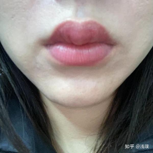 纹唇后几天消肿亲身经历